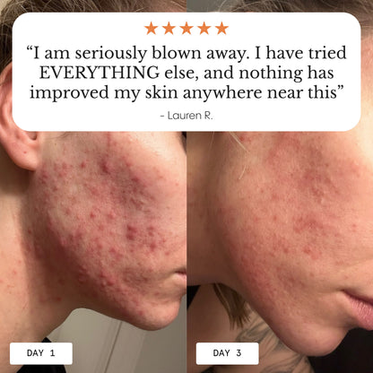 The Complete System for Acne-Prone Skin
